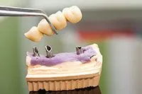 Dental Bridge 