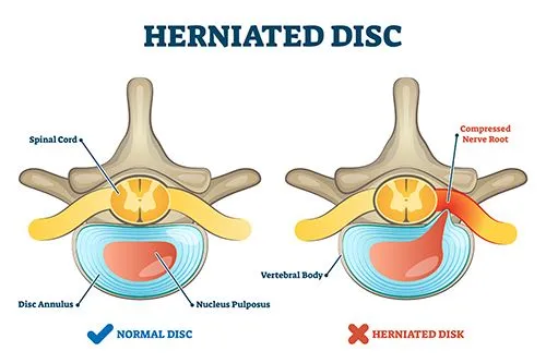 Herniated-Disc-Treatment-in-Midtown-Manhattan