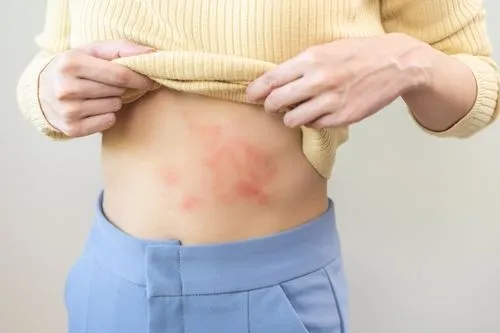 Woman suffering from rashes in allergy of shirt