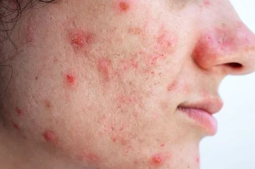 Acne Treatment in Dallas, TX Serving Kessler & Cedar Crest, TX