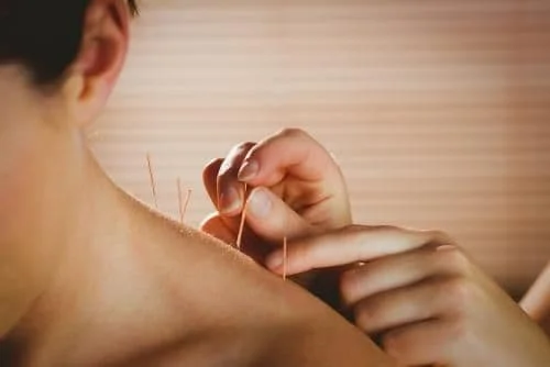 man receiving acupuncture therapy