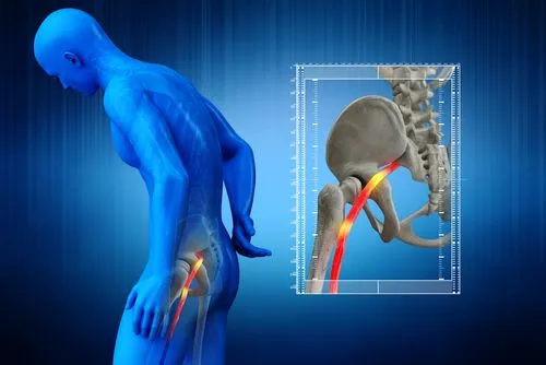 Illustration highlighting sciatica pain along the nerve pathway.