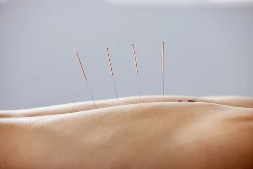 Acupuncture-FAQs-in-Salisbury-MD