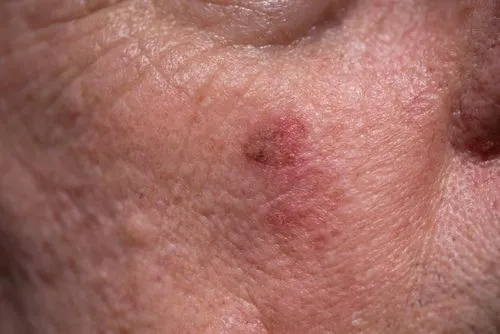 Close-up of actinic keratoses on the face caused by sun damage