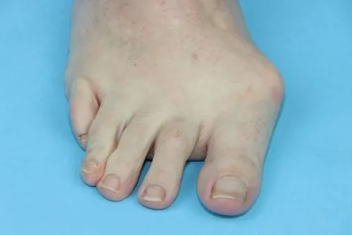 Close-up of foot with bunion on blue background