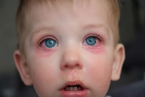 Close-up of a child's eyes affected by conjunctivitis