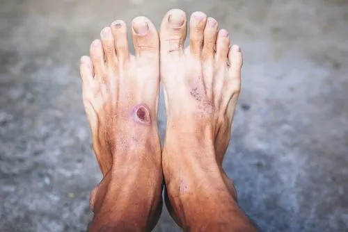 Foot wound on a patient foot