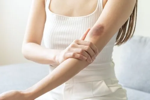 Illustration of hematoma injury