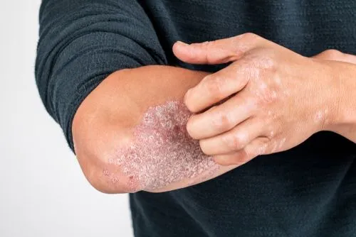 man with psoriasis