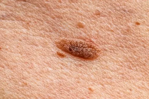 Skin mark or mole on a person