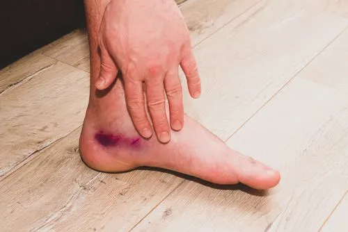 Close-up of an ankle sprain with visible bruising and swelling.