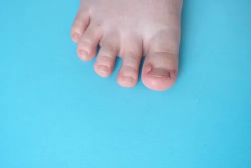 Ingrown Toenail Treatment in Ridgefield, CT Serving Danbury & Redding, CT