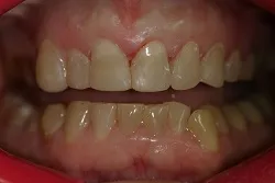 patient's mouth, close up showing teeth after smile makeover with cosmetic fillings Cumberland Park, SA dentist