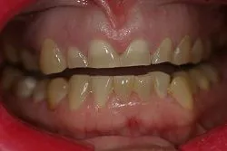 patient's mouth, close up showing upper and lower teeth, teeth are short and worn needs dentist Adelaide SA