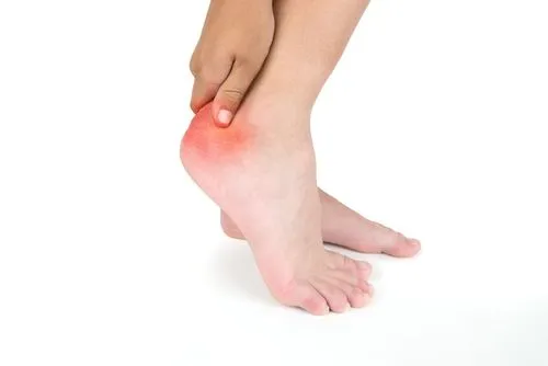 Close-up of foot showing Achilles tendonitis on a white background.