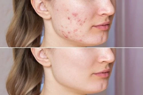 acne in chevy chase dermatology center