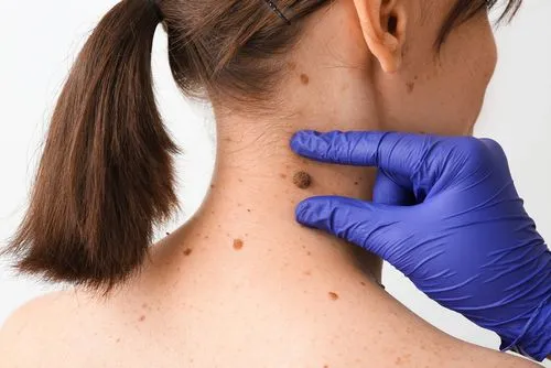 Dermatologist performing mole and freckle check on female client's skin.