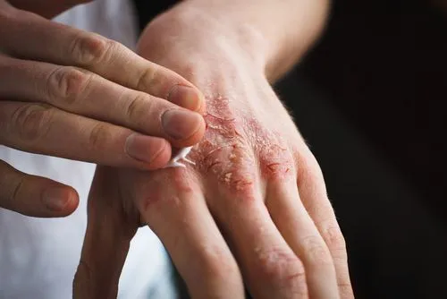 Eczema Treatment in Dallas, TX Serving Kessler & Cedar Crest, TX