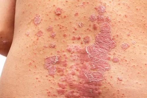 Psoriasis Treatment in Dallas, TX Serving Kessler & Cedar Crest, TX