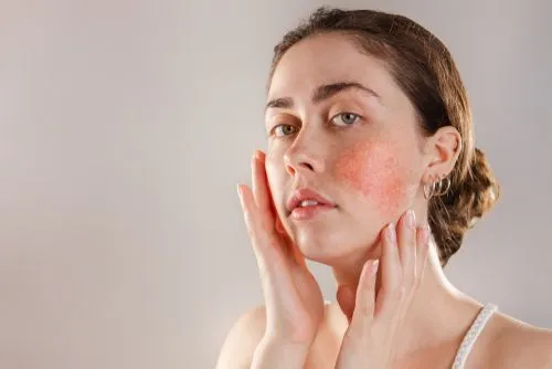 Rosacea Treatment in Dallas, TX Serving Kessler & Cedar Crest, TX