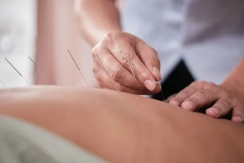 Client receiving acupuncture treatment