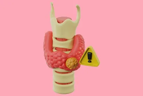 Anatomical model of the thyroid gland showing a visible thyroid nodule
