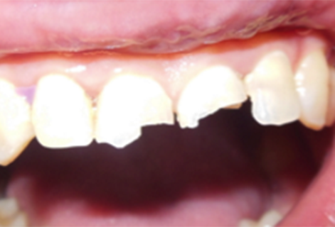 Anterior Crowns (Case 4) Before