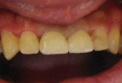Anterior Crowns (Case 4) After