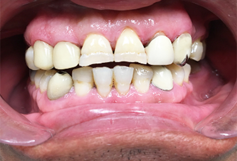 Anterior Crowns (Case 5) Before