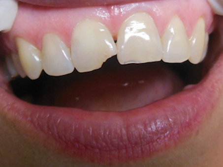 Anterior Crowns (Case 2) - Before Treatment