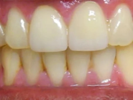 Anterior Crowns (Case 3) - After Treatment