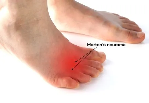 Illustration of Neuroma