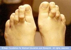 Hammertoe1.jpg