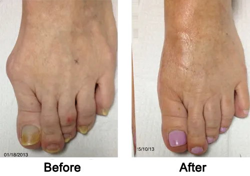 Cosmetic Foot Surgery Before and After 2