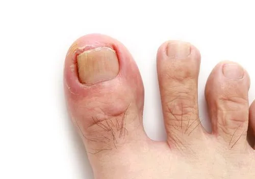 Close-up of ingrown toenail on white background
