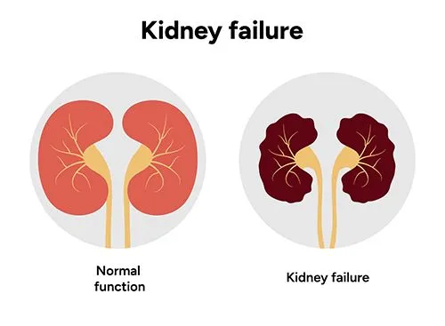 Medical illustration comparing a normal kidney to one with kidney failure.