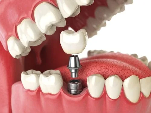 Dental Implant procedure in D.C.