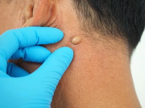 Dermatologist preparing a patient for cyst removal procedure