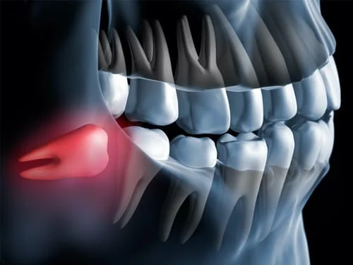 Oral Surgery - Thousand Oaks, CA Dentist | Laura Fathi D.D.S.