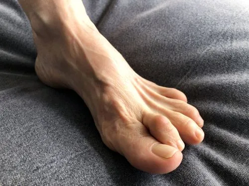 Foot with hammertoe deformity 