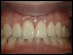 Gingivoplasty_F Neal Pylant Athens GA_Periodontics_Dental Implants