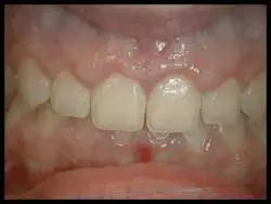 Gingivoplasty_F Neal Pylant Athens GA_Periodontics_Dental Implants