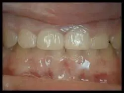 Gingivoplasty_F Neal Pylant Athens GA_Periodontics_Dental Implants