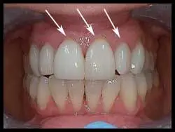 Semilunar Grafts_F Neal Pylant Athens GA_Periodontics_Dental Implants