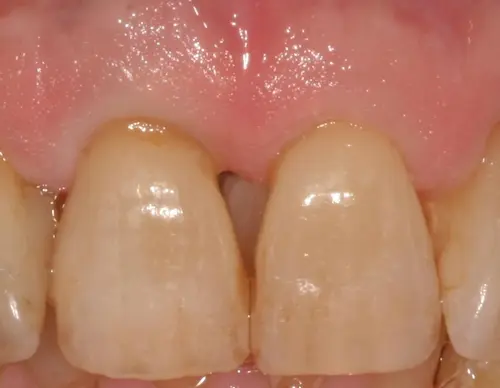 Gum Recession Before