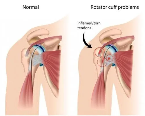 Rotator cuff problems