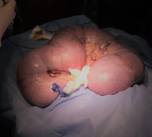 Uterus out for delivery