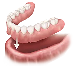 dentures_2_no_background_Boogren