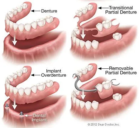 dentures