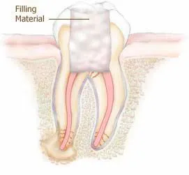 Root Canals Fillings in Lehi, UT